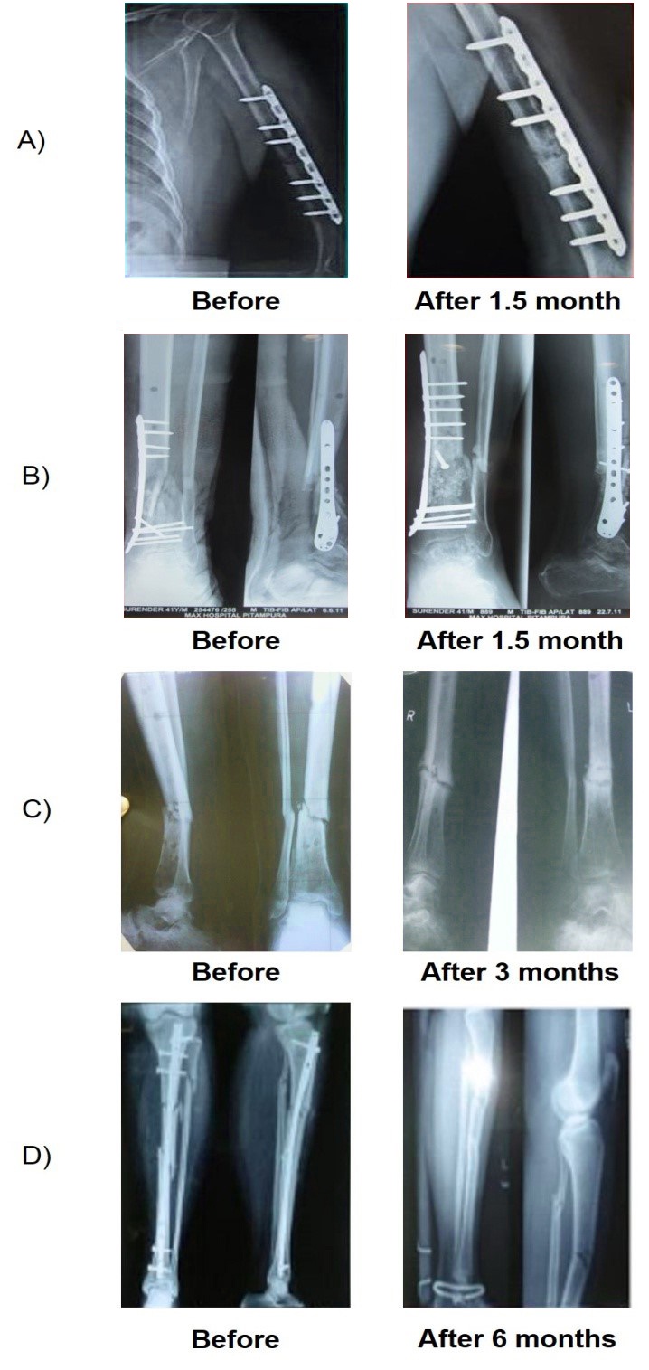 Enhancement of Atrophic NonUnion Fracture Healing Using Autologous